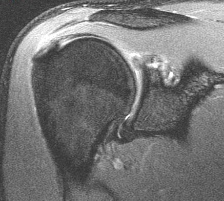 Figure 2 for case Posterior Peel Back Lesion of Internal Impingement